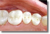 A mercury-free dentist places only tooth-colored composite fillings like the ones shown here on three posterior teeth.
