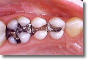 A mercury-free dentist doesn't place metal fillings like the restorations shown here on three posterior teeth.
