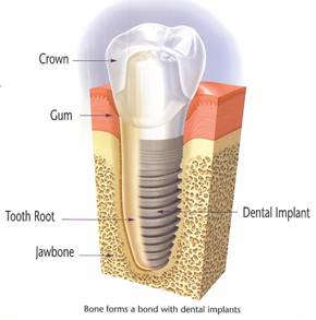 Diagram depicting the main elements of dental implants and how they fuse with the bone in the jaw.