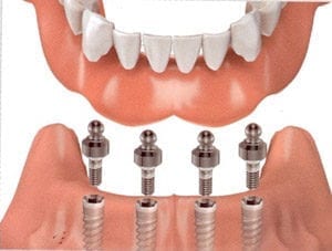 Illustration depicting implant overdentures with four implants.