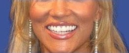 A woman's teeth look bigger and rounder after getting Lumineers placed.