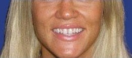 A woman's teeth before getting Lumineers