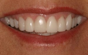 After photo showing teeth after receiving all porcelain crowns.