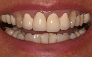 A before photo of teeth with porcelain-fused-to-metal crowns before getting all porcelain crowns.