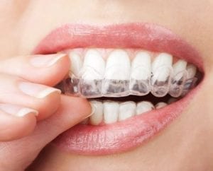 A professionally-made take-home custom tray for teeth whitening.