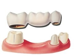A dental bridge