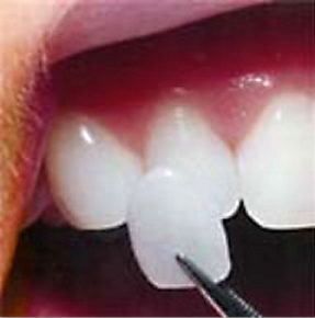 porcelain veneers placement