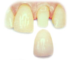 Dental Crown Being Placed on a tooth