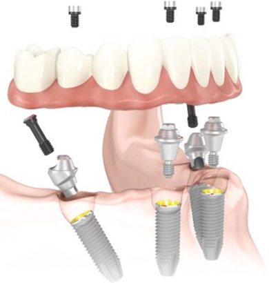 all-on-4 dental implants