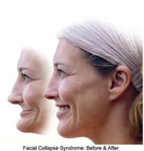 An image showing before and after facial collapse