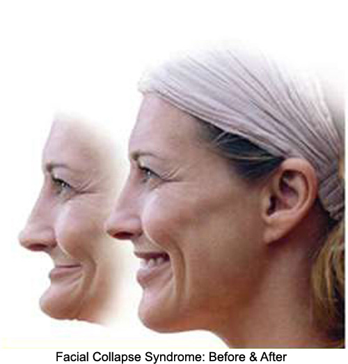 An image showing before and after facial collapse